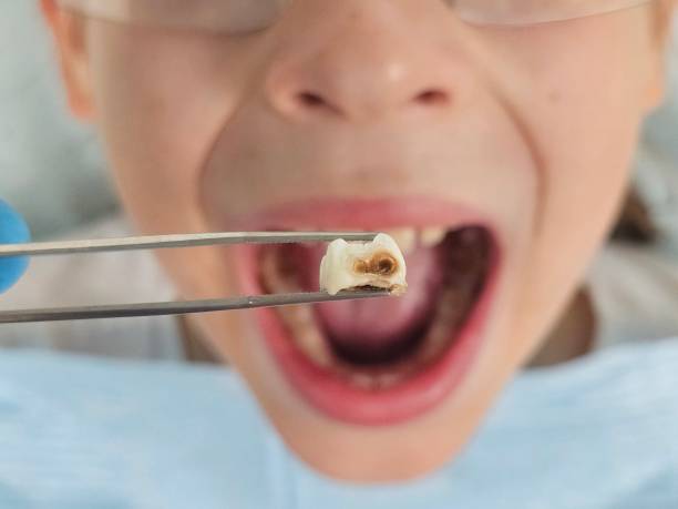 Best Emergency Tooth Extraction in Volga, SD