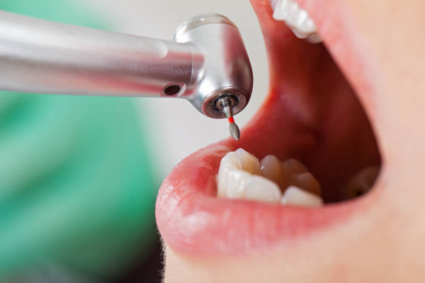 Best Emergency Broken Tooth Repair in Volga, SD